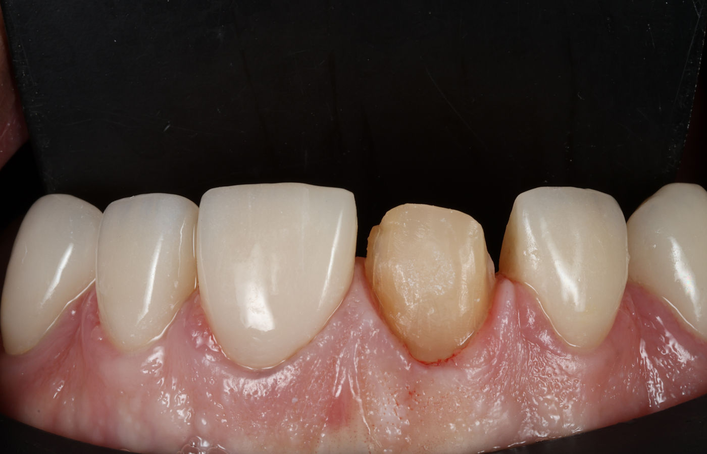 Clinical photograph of a prepared upper central incisor, darker than the adjacent teeth and reduced ready for a full-coverage crown