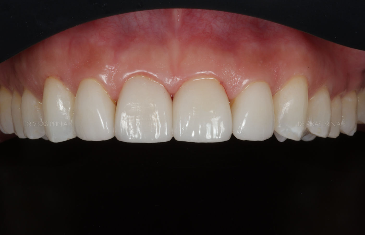 The same upper front teeth after four minimal-preparation e.max ceramic veneers, showing even edge position, balanced width and natural translucency