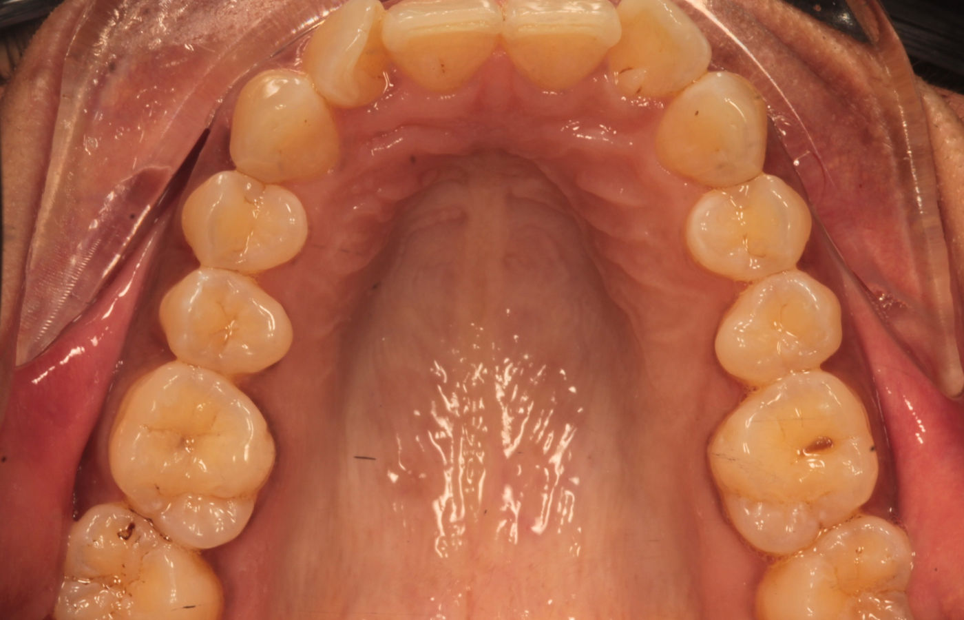 Clinical photograph of upper and lower teeth before treatment, showing spacing, uneven edges and shade variation