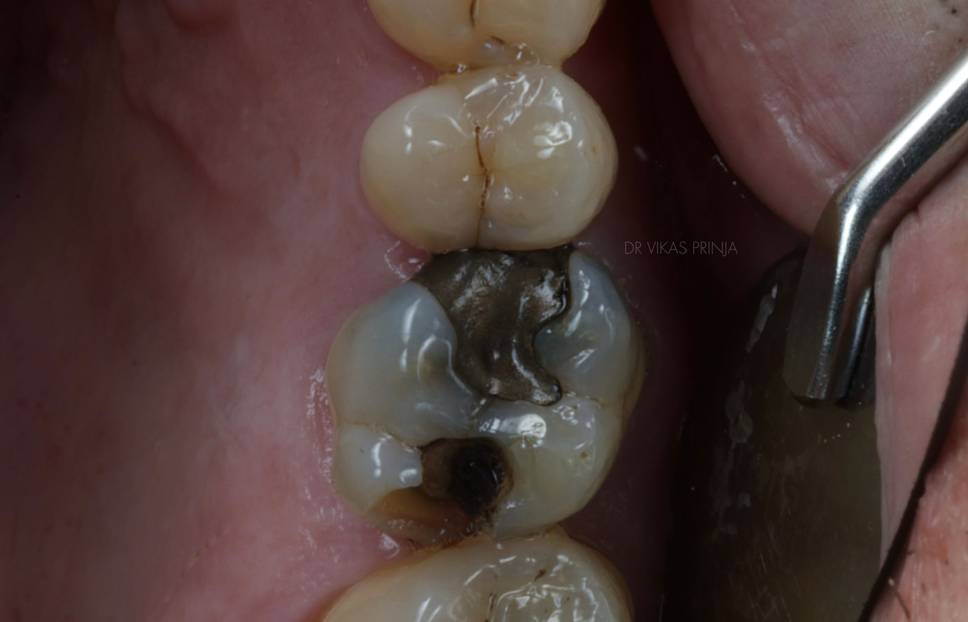 Clinical photograph of a back tooth with a large failing restoration and insufficient remaining tooth structure