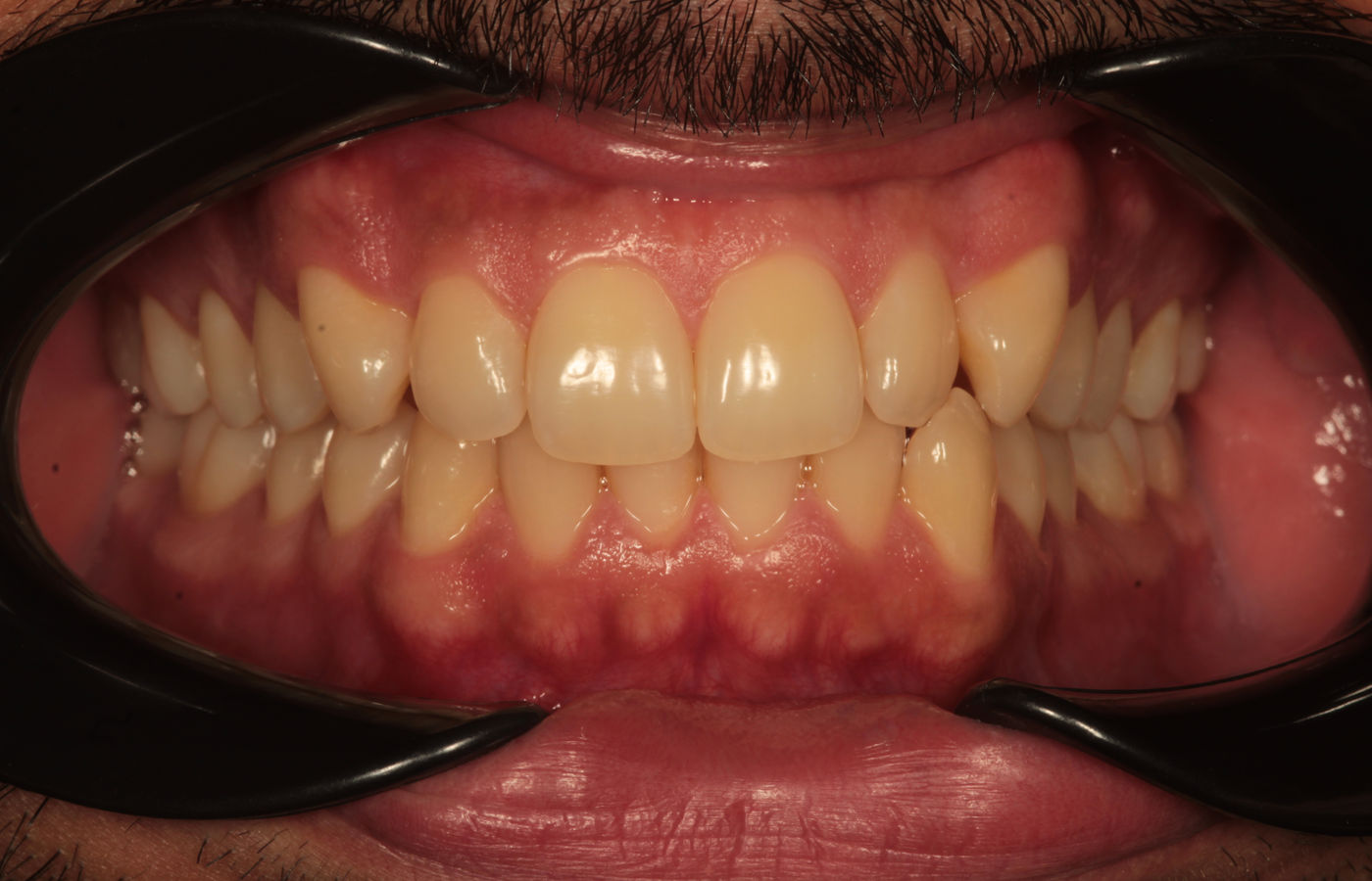 Clinical photograph of a smile before treatment, showing crowded and rotated upper front teeth with a darker overall shade