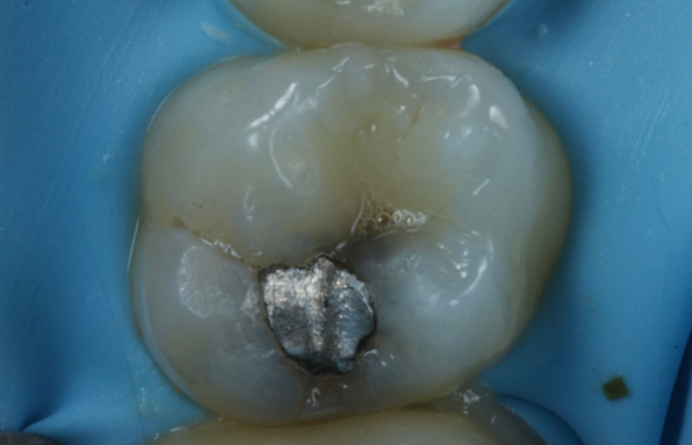 Clinical photograph of a tooth with an old silver amalgam filling and visible decay at the margins