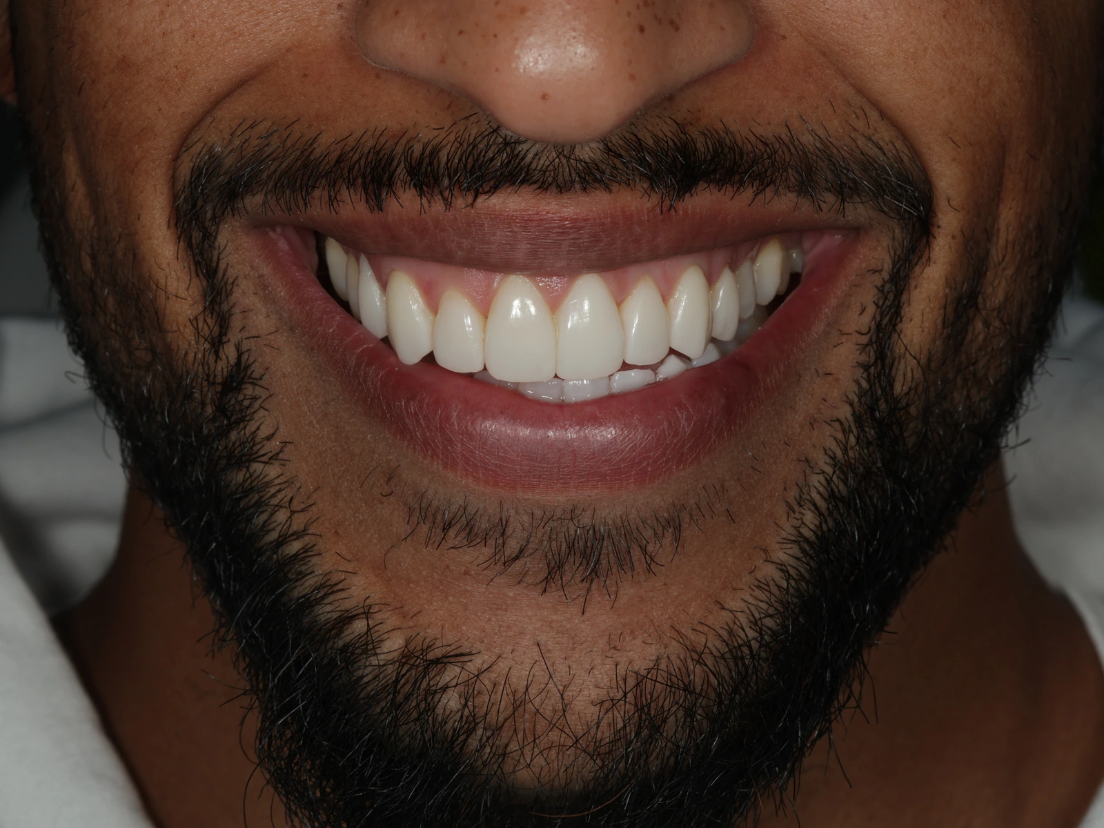 The same patient’s smile after treatment, supplied by Dr Vikas Prinja