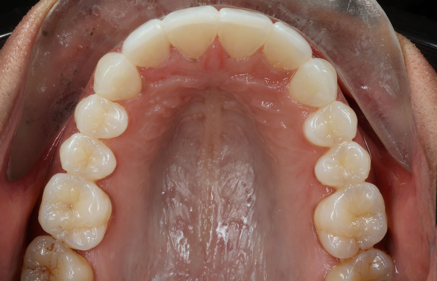 The same teeth after alignment, whitening and composite bonding, with spaces closed and edges evenly contoured