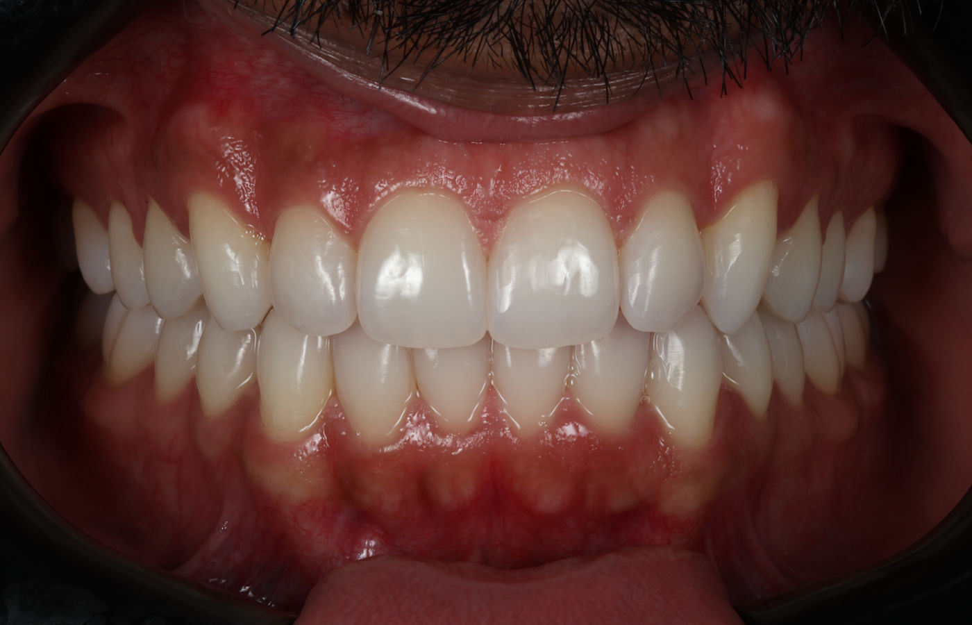 The same smile after alignment, whitening and composite bonding, showing straight teeth, a lighter shade and even incisal edges