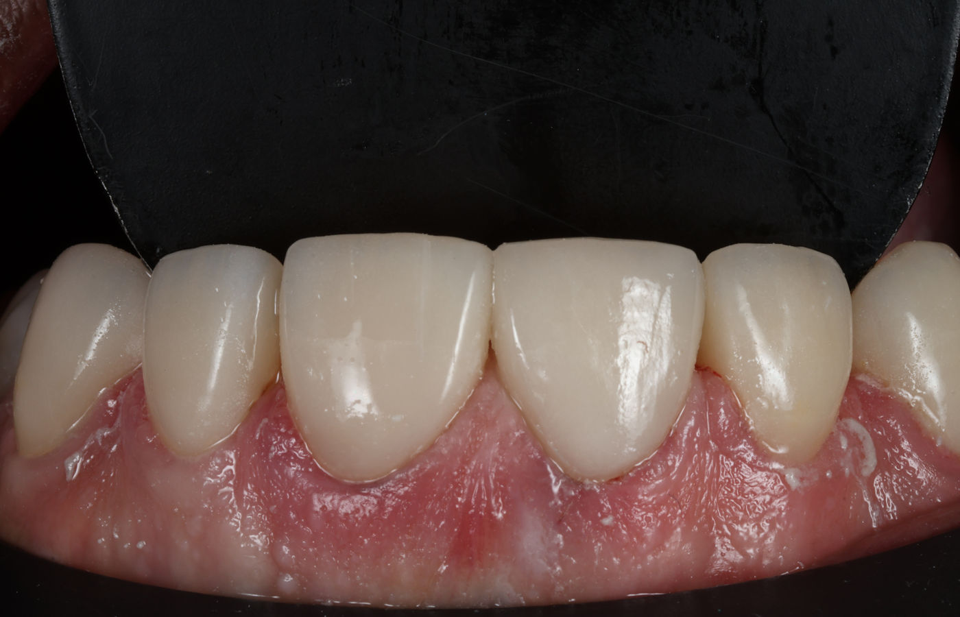 The same central incisor restored with a bonded e.max ceramic crown, matched in shade, translucency and surface texture to the neighbouring teeth