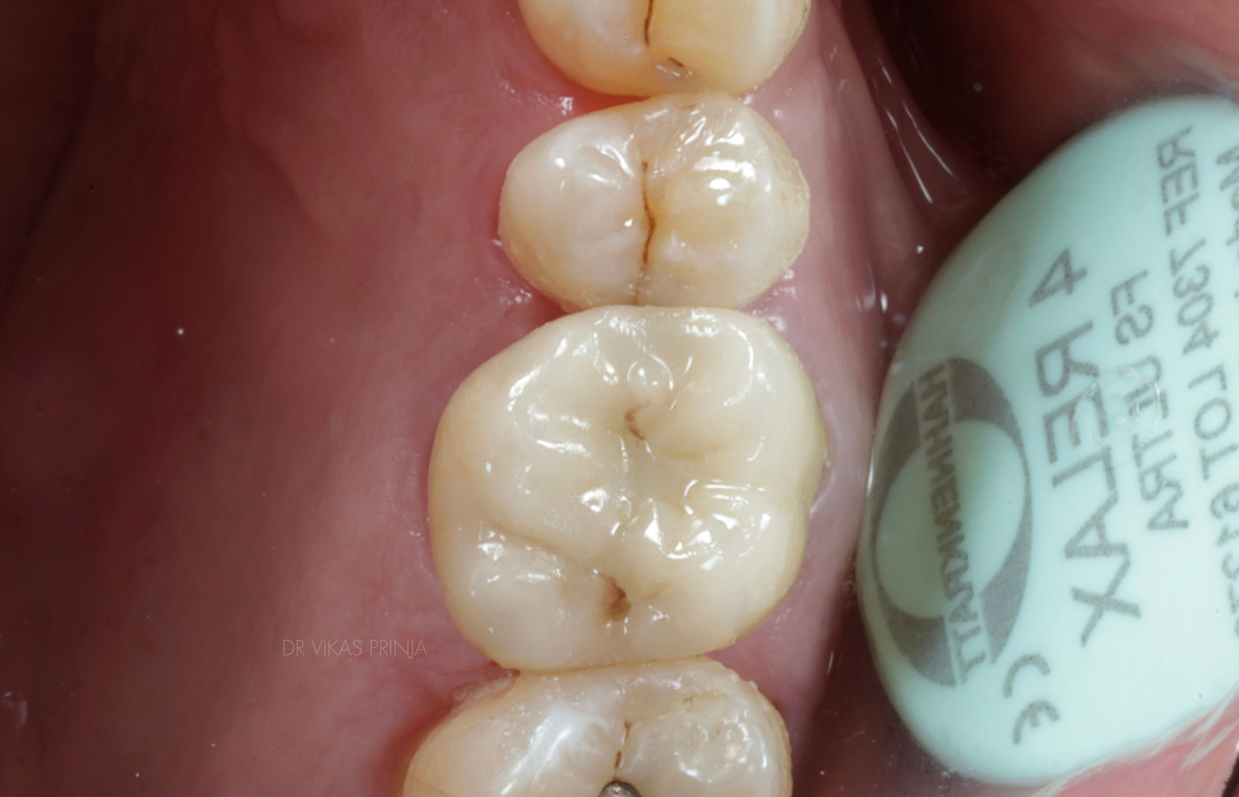 The same molar restored with a bonded e.max ceramic crown, with restored cusp form and a checked bite