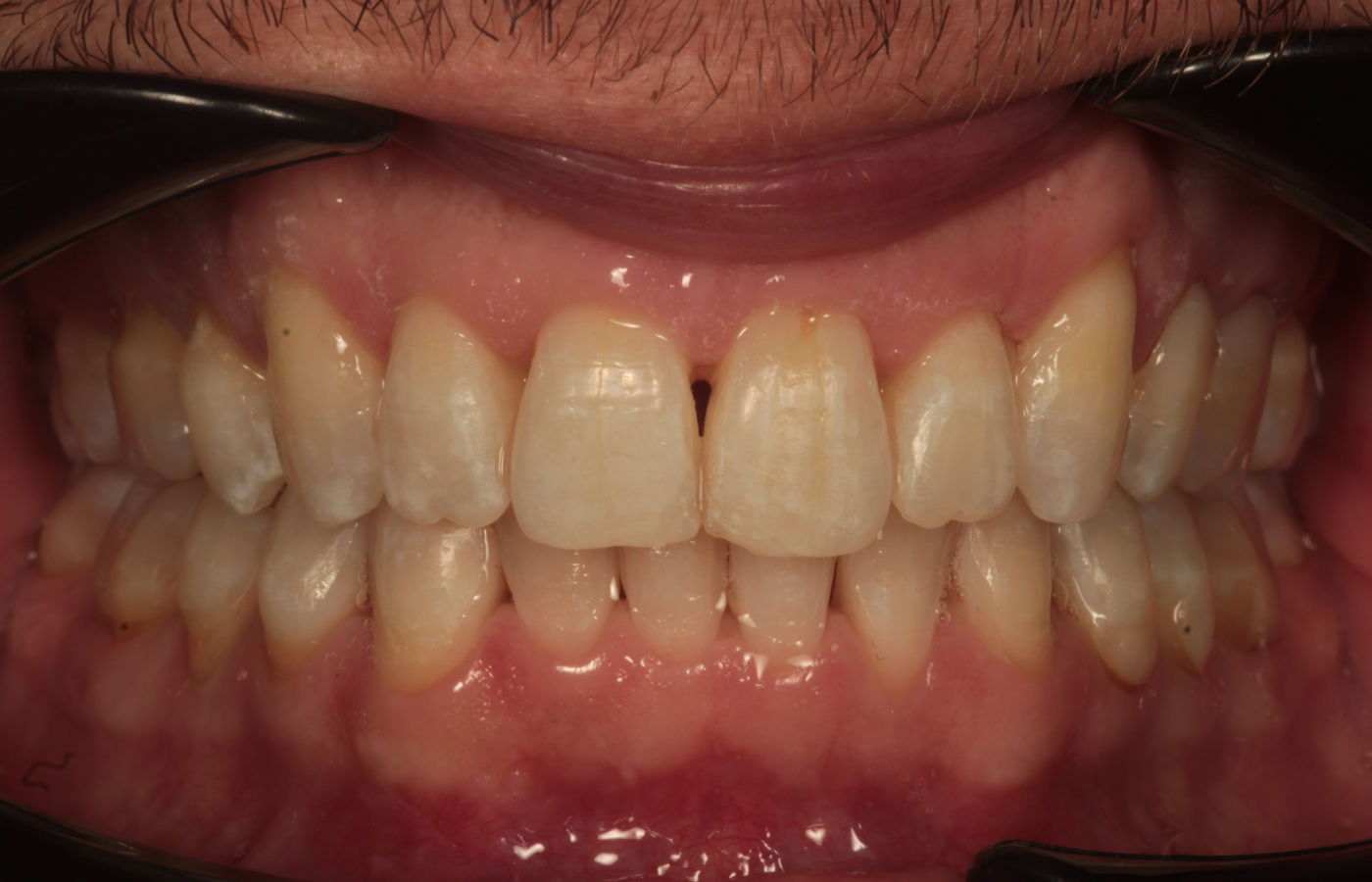 The same teeth after Invisalign and professional whitening, aligned and several shades lighter