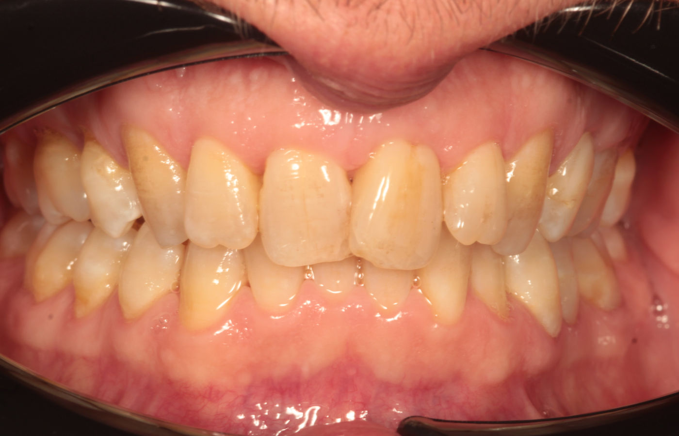 Clinical photograph before treatment showing irregular upper tooth position and a yellowed natural shade