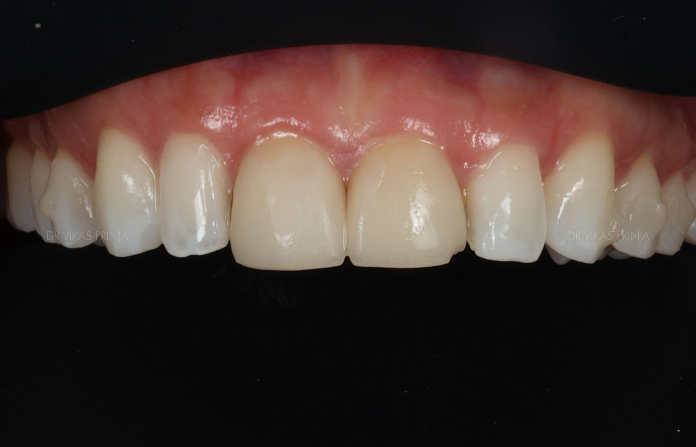 Close-up clinical photograph of upper front teeth before treatment, showing uneven edge position, worn incisal edges and mismatched proportions