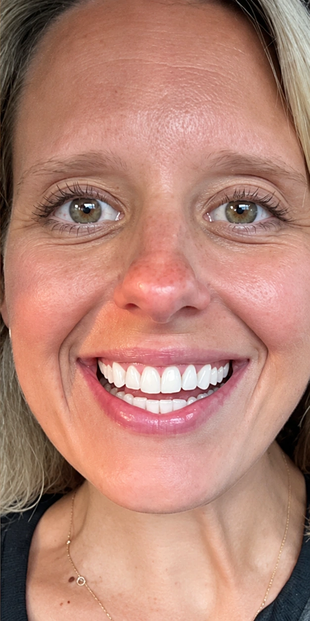 The same patient smiling after Invisalign treatment, from the supplied Open Day case photograph