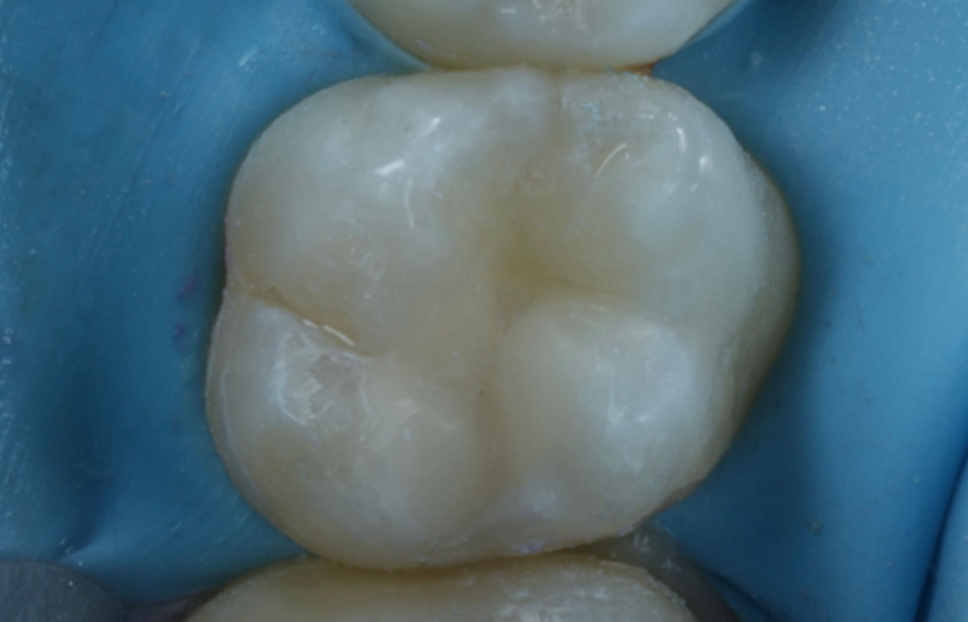 The same tooth restored with a bonded tooth-coloured composite filling, with anatomy and contact point rebuilt