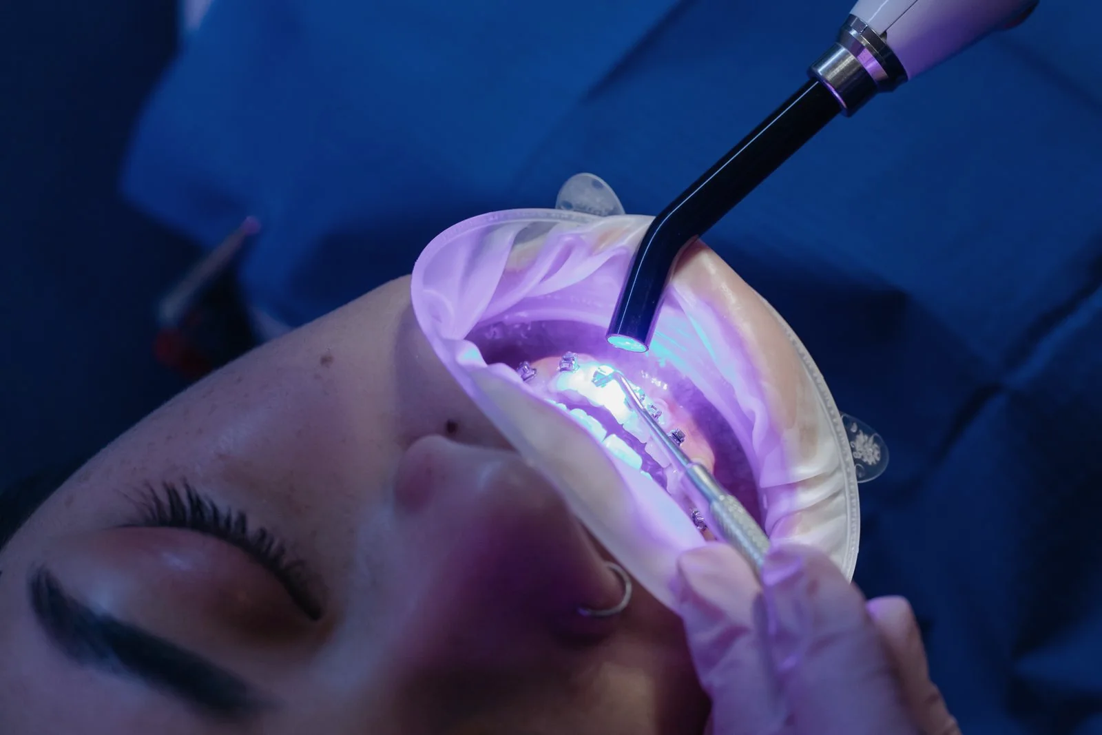 Dentist applying and curing tooth-coloured restorative material on front teeth