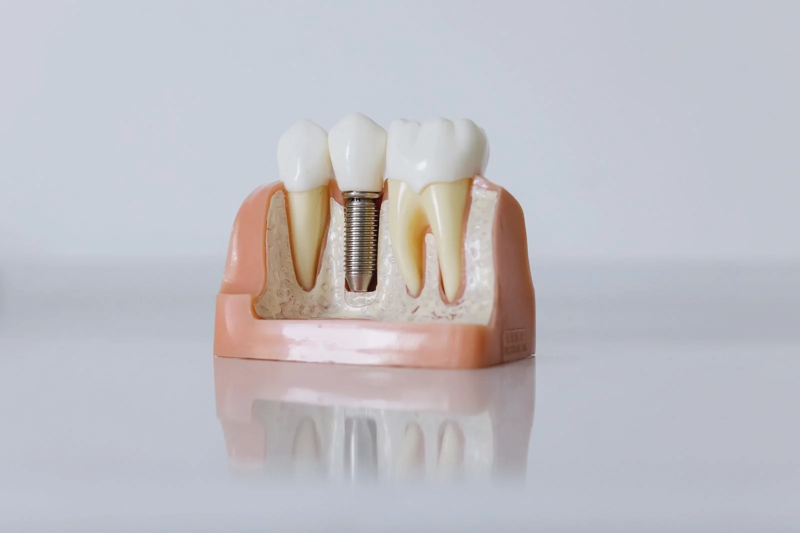 Anatomical dental model showing an implant fixture supporting a replacement crown